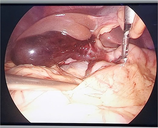Gallbladder contusion and free blood in the peritoneal cavity.