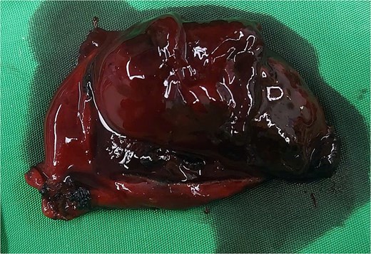 Intramural gallbladder hematoma.