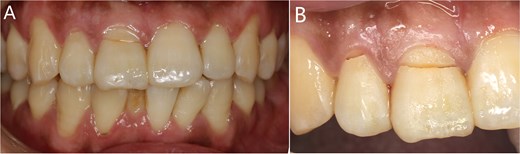 (A) The whole teeth photograph; (B) The fracture lines in teeth 11 and 12.