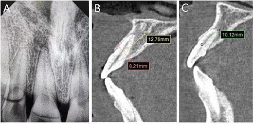 Imaging examinations. (A) The dental film; (B) 11 tooth position in CBCT images; (C) 12 tooth position in CBCT images.