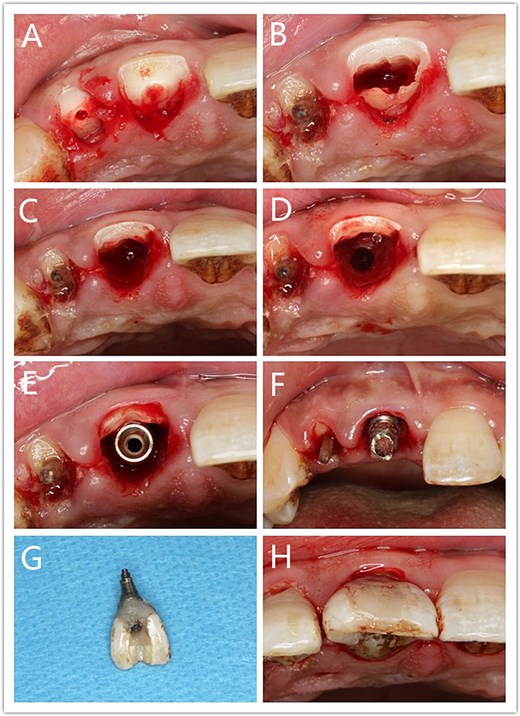 Socket shield technique and immediate restoration procedure; (A) Remove broken tooth tissues; (B) Separate the tooth root; (C) Remove the lingual root segment; (D) Prepare implant site; (E) Place implant; (F) Temporary abutment; (G) Temporary crown; (H) Temporary prosthesis.