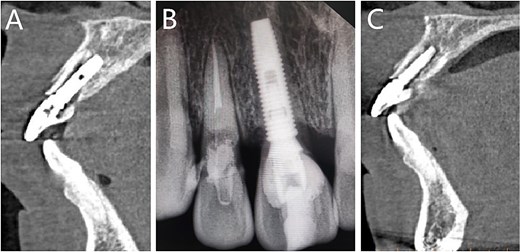 Follow-up imaging examinations. (A) Postoperative CT; (B) X-ray performed one month later; (C) CBCT performed 6 months later.