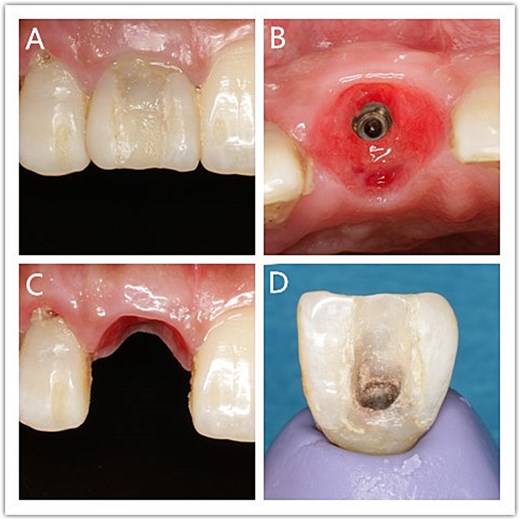 Personalized impression procedure. (A) The buccal gingival margin; (B) Emergence profile; (C) Gingival contour; (D) Personalized mold tool.