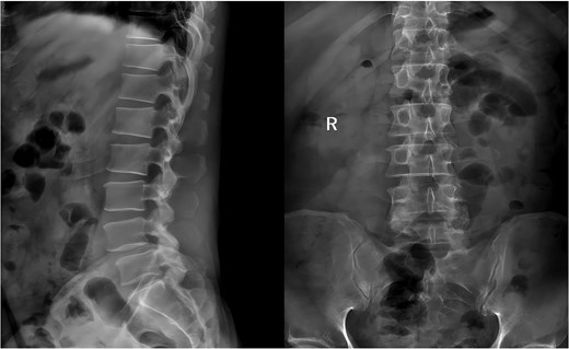 Preoperative anteroposterior and lateral radiographs of the lumbar spine.