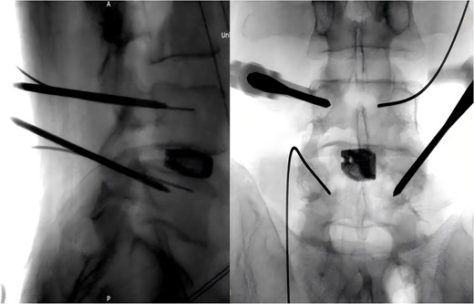Intraoperative placement of the pedicle screw.