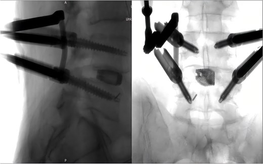Intraoperative fluoroscopic confirmation of guidewire breakage.