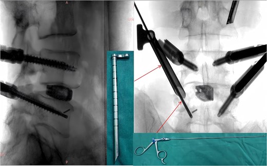 Endoscopic forceps localizing the fractured guidewire.
