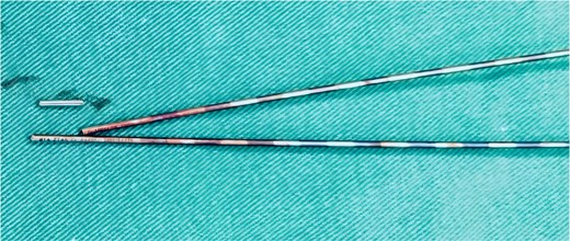 The fractured guidewire during surgery.