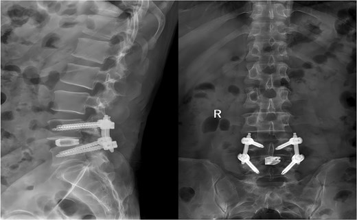 Postoperative anteroposterior and lateral radiographs of the lumbar spine.