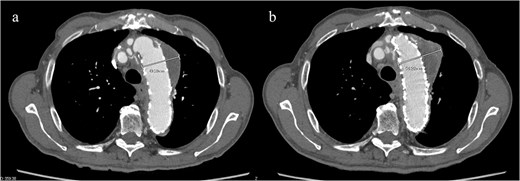 (a) Contrast-enhanced CT 1 year after total arch replacement with FET showing a reduction in aneurysm diameter from 55 mm to 49 mm, with no evidence of endoleak. (b) Contrast-enhanced CT 2 years after total arch replacement with a FET, showing an increase in aneurysm diameter to 56 mm.