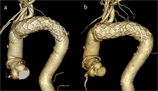 (a) Three-dimensional CT image 1 year after total arch replacement with a FET. (b) Three-dimensional CT image 2 years after total arch replacement with a FET demonstrating straightening and migration of the FET.