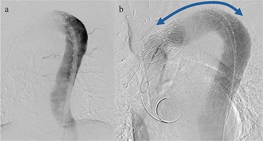 (a) Angiography performed from within the FET before deploying the stent graft showing no evidence of endoleak or aortobronchial fistula. (b) Angiography after stent graft placement. The bidirectional arrow shows the original extent of the FET insertion.