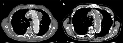 (a) Contrast-enhanced CT performed soon after TEVAR showing an aneurysm diameter of 56 mm. (b) Two years later, contrast-enhanced CT showing a reduction in the aneurysm diameter to 44 mm.