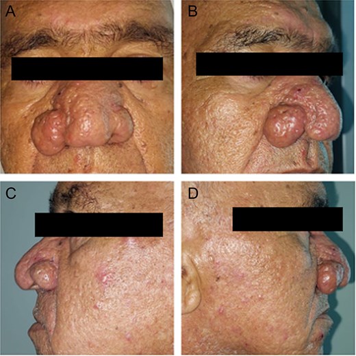 Patient 1. (A) Patient front before the surgery. (B, D) Patient right profile before the surgery. (C) Patient left profile before the surgery.