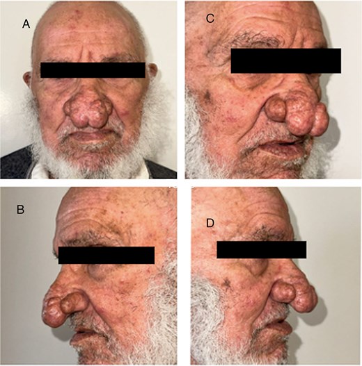 Patient 2. (A) Front view. (B) Left profile. (C, D) Right profile.