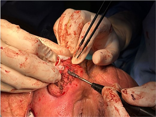 Electrocautory to reduce the mass and carving the surface of the nose using the blade tip.