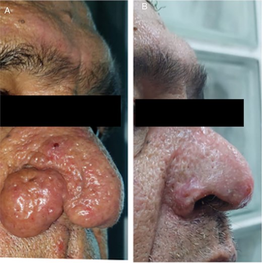 Patient 1. (A) Before the surgery. (B) After the surgery.