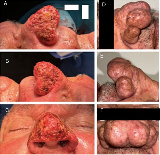 Patient 2. (A–C) After surgery. (D–F) Patient before surgery.