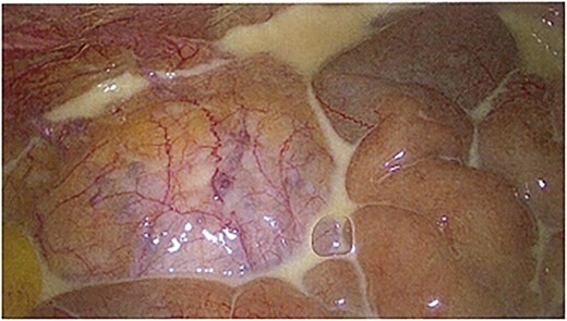 Laparoscopic image showing chyle found on entry to the peritoneal cavity.