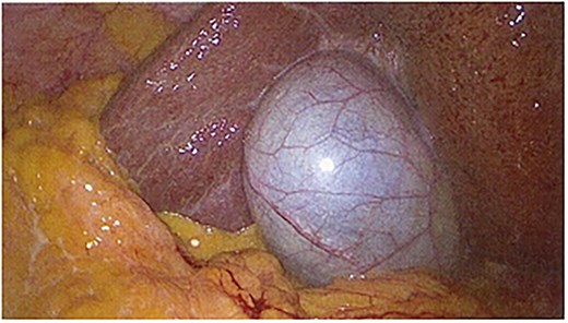 Laparoscopic image showing a thin-walled gallbladder prior to cholecystectomy.