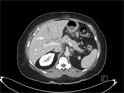 Axial slice of post-operative CT scan showing features of chronic pancreatitis.