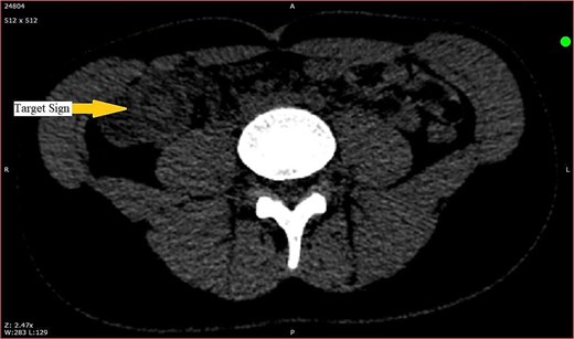 CT scan showing target sign in the right iliac fossa, suggestive of ileocecal intussusception.