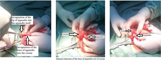 Intraoperative image showing Type IV AI with mucocele.