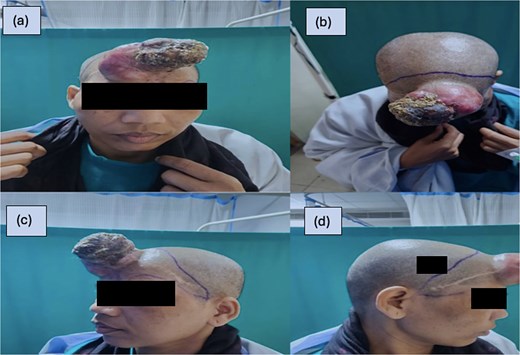 (a–d) The tumor with the marking of incision line for wide local excision.
