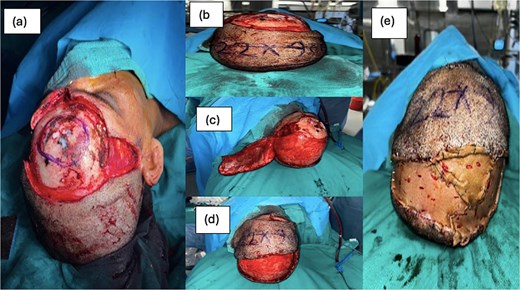 (a) Forehead defect after wide local excision, (b) marking of rotational flap, (c) raising of flap, (d) in setting of flap onto forehead defect, (e) SSG cover over posterior scalp defect.
