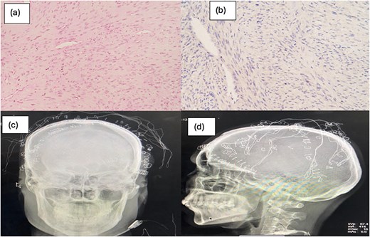 (a, b) Tumor cells arranged in fascicles and herring bone pattern and slit like and staghorn blood vessels; (c, d) post op skull X-ray anteroposterior view and lateral view, respectively, showing marking of deep posterior margin of excised tumor.