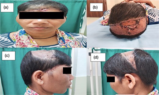 (a–d) The post op status after 6 weeks.