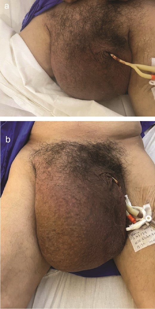 Clinical image of a bulge in the right inguinal region, approximately 25 × 22 cm in size, exacerbated by urine retention, without changes in coloration (a), and the same right inguinal bulge demonstrating how the size of the bulge increases with urine retention (b).