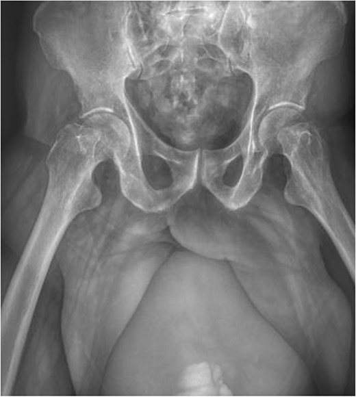 Simple anteroposterior pelvic radiograph.