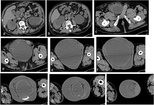 Simple abdominopelvic CT scan slices showing significant dilation of the renal collecting system, measuring 40 mm on the right side and 62 mm on the left, with an increase in the diameter of the ureters (a–c), an aponeurotic defect in the right inguinal region with protrusion of the urinary bladder into the inguinal canal (d–f), and the bladder completely full and entirely located within the right scrotal sac (g–i).