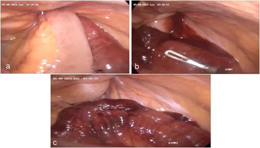 Laparoscopic procedure for inguinal hernia repair using polypropylene mesh showing (a) visualization of the deep inguinal ring with herniated bladder content and ileum loop, (b) detail of marbled changes and inflammatory exudate on the intestinal loop, and (c) reduction of the herniated intestinal and bladder contents using traction without resistance.