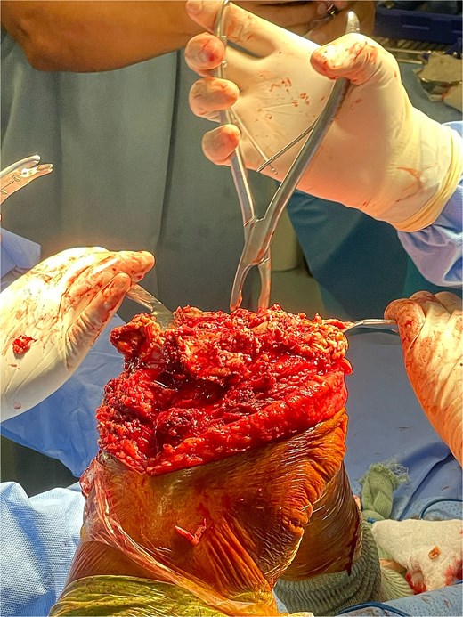 Total knee prosthesis revision surgery. This image depicts the surgical site during the revision of the left total knee prosthesis. The femoral component is seen to be loosened and fractured, with significant bone necrosis surrounding the prosthetic implant. The revision surgery involved the removal of the failed prosthesis and the use of a custom implant designed to accommodate the patient’s underlying bone abnormalities.