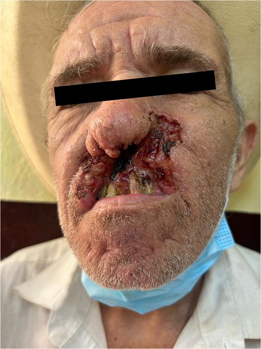 Oral mucosal infiltrative basal cell carcinoma. Image shows a biopsy-proven infiltrative basal cell carcinoma on the buccal mucosa of the patient. The lesion appears as an ulcerated, slow-growing mass with irregular borders. The presence of significant tissue invasion is evident, which led to the decision for surgical excision and radiation therapy.