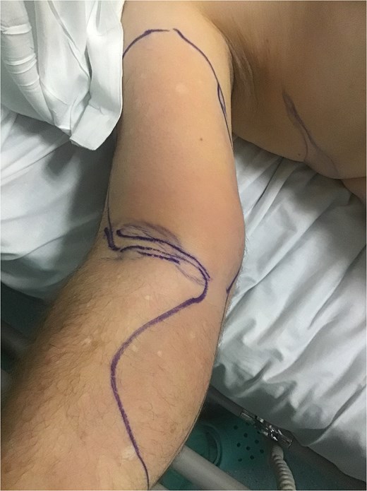 Right arm at presentation.