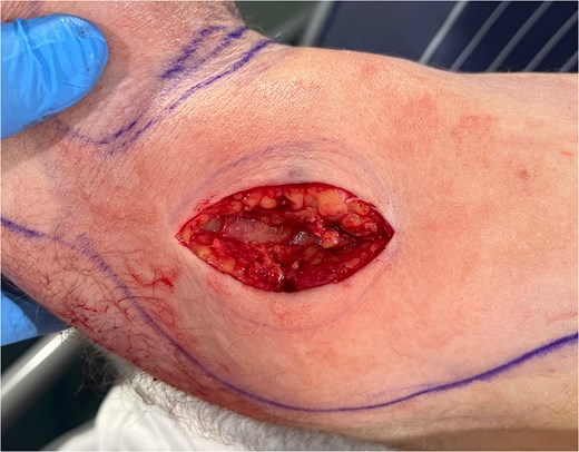 Negative sweep test.