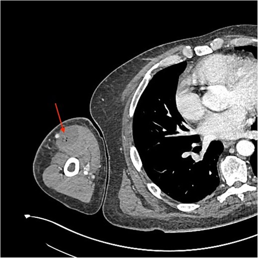 CT scan showing gas loculi within the biceps (arrow).