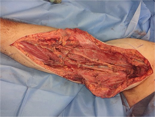 Right arm after debridement.