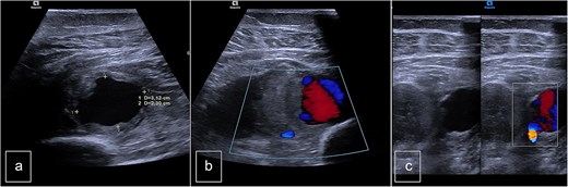 Preoperative duplex sonography. (a) M-mode. Pseudoaneurysm of the posterior tibial artery (vascularized anechogenic pocket). (b) Doppler mode and (c) Doppler mode. Identification of communication with the medial wall of the PTA.
