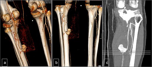 Computed tomography. (a) Lateral view, (b) posterior view, and (c) vascular reconstruction. The medial wall of the posterior tibial artery appeared discontinuous over a length of ~6 mm.