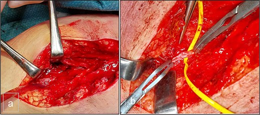 (a) Preoperative view. (b) Preoperative view. PTA after resection of the pseudoaneurysm and before the autologous patchoplasty.