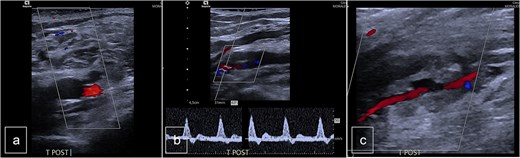 Postoperative duplex sonography. (a) Doppler mode. Identification of the PTA. (b) Doppler mode. Triphasic physiological flow in distality of the autologous patch. (c) Doppler mode. Permeability of the PTA.