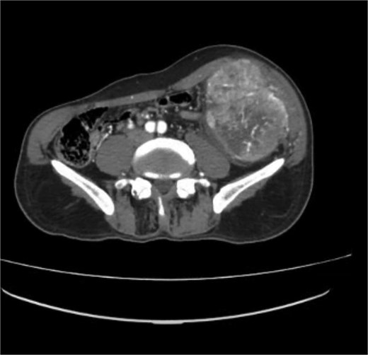 Contrast-enhanced CT scan of the abdomen showing a heterogeneously enhancing soft tissue lesion in the left iliac fossa.