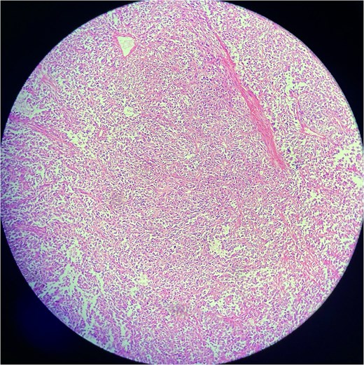 Low-power view of a solitary fibrous tumor showing a well-circumscribed lesion composed of spindle-shaped cells in a collagenous stroma. Alternating cellularity and staghorn-like branching vasculature are evident.