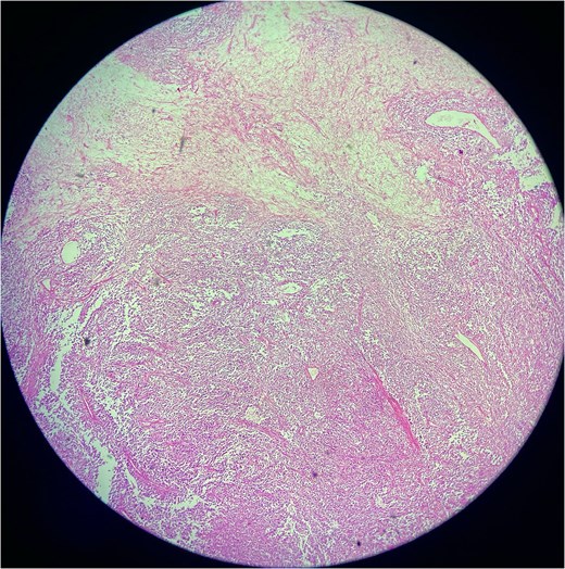 Low-power photomicrograph of a solitary fibrous tumor showing areas of tumor necrosis characterized by loss of cellular detail and eosinophilic ghost-like zones, along with alternating hypercellular and hypocellular regions and staghorn-like vasculature.