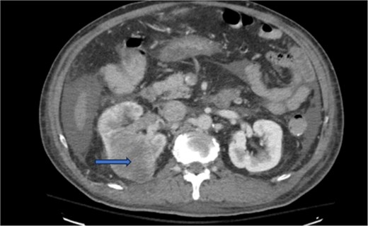 CT chest abdomen and pelvis with contrast showing middle portion of right with tumor during venous phase venous phase.