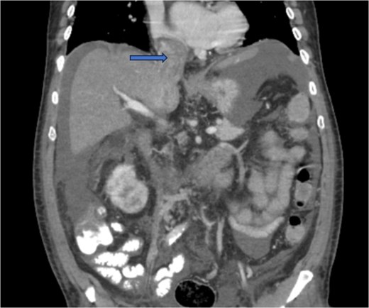 CT chest abdomen and pelvis with contrast showing tumor thrombus is seen within the IVC extending over a long distance from the level of the renal vein cephalad into the right atrium.